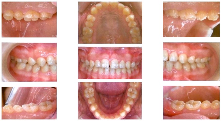カリエスフリー 成功例をお見せします – 横浜歯科クリニック 予防歯科サイト
