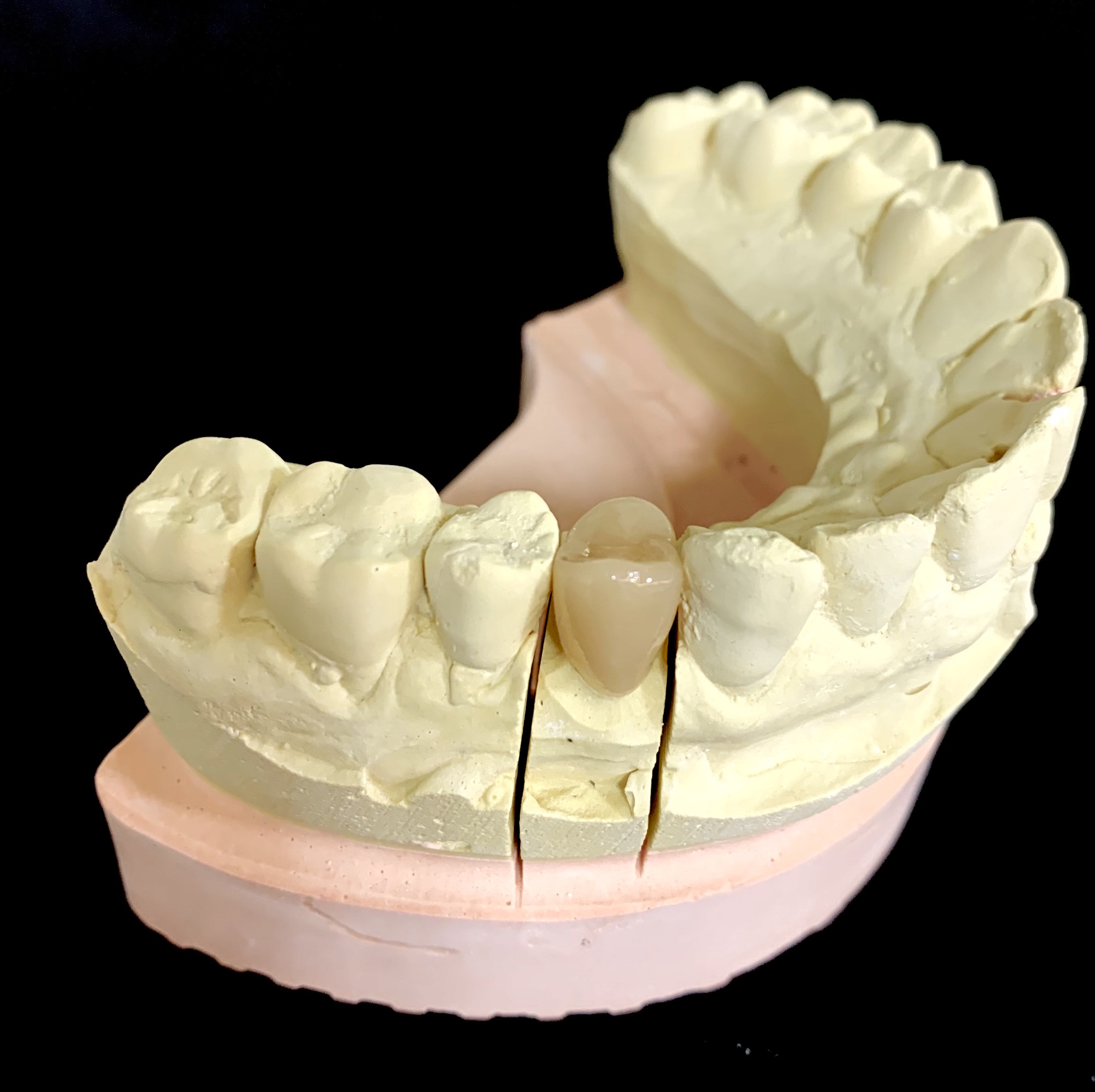 CAD/CAM冠って何？ | 白い歯.club